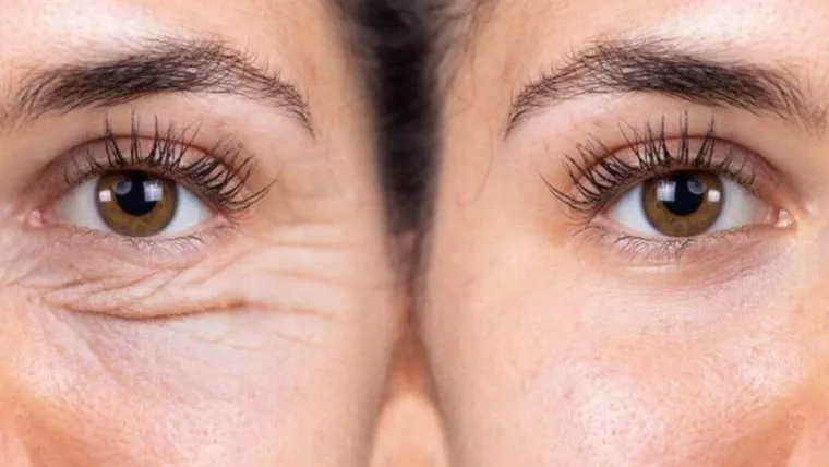 Antes e depois de cirurgia plástica ocular na Eye Center